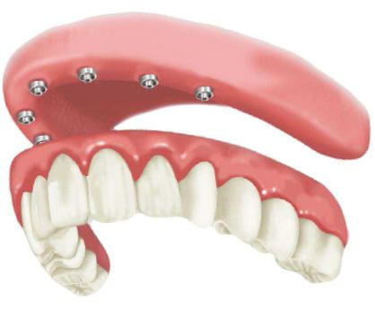 Próteses Dentárias